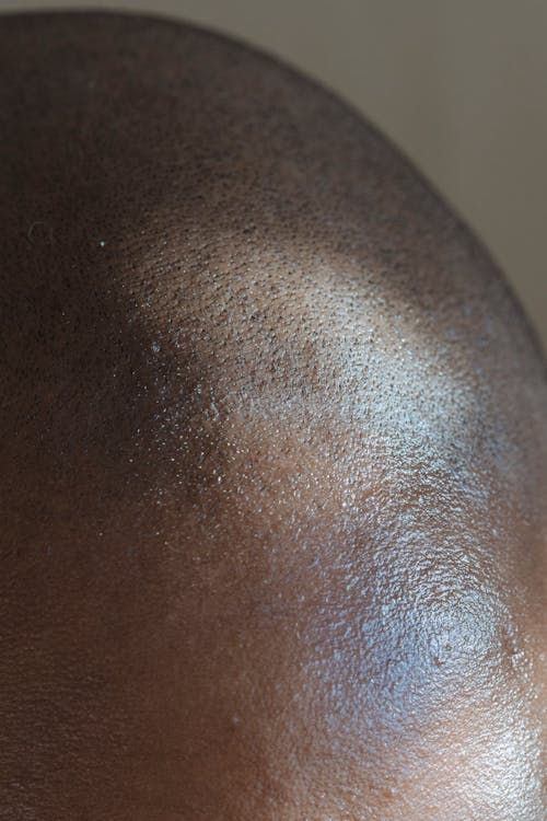 Male hair loss treatment foam Finasteride Minoxidil